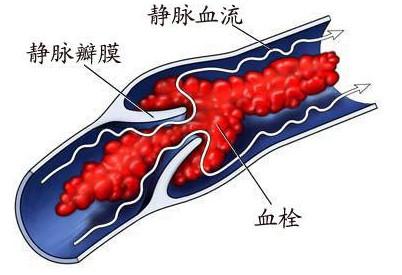 术后刀口流水怎么回事,胸腔镜术后刀口流水是什么原因