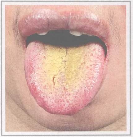 从舌头看身体状况拍照,如何看舌头判断孩子身体状况