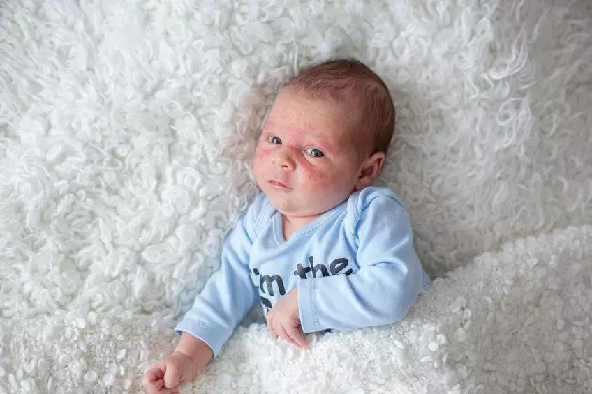 湿疹治标不治本怎么办,湿疹治不了根