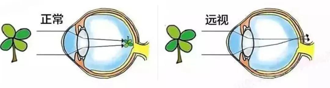 孩子远视眼怎么治疗啊,孩子远视怎么治疗