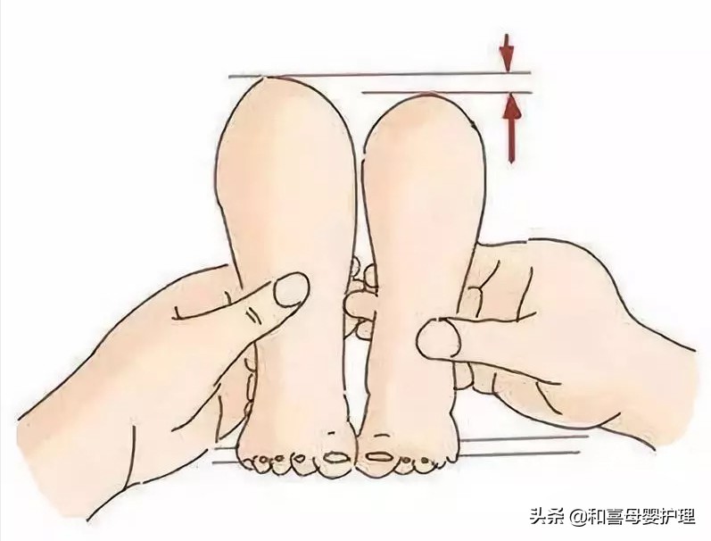 宝宝臀纹不对称是腿部畸形吗,宝宝臀纹不对称腿纹对称