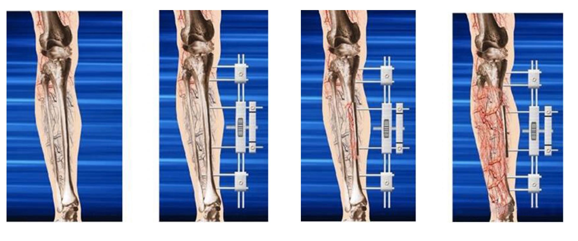 糖尿病足截肢后怎么长肉快,糖尿病足不截肢的最新疗法