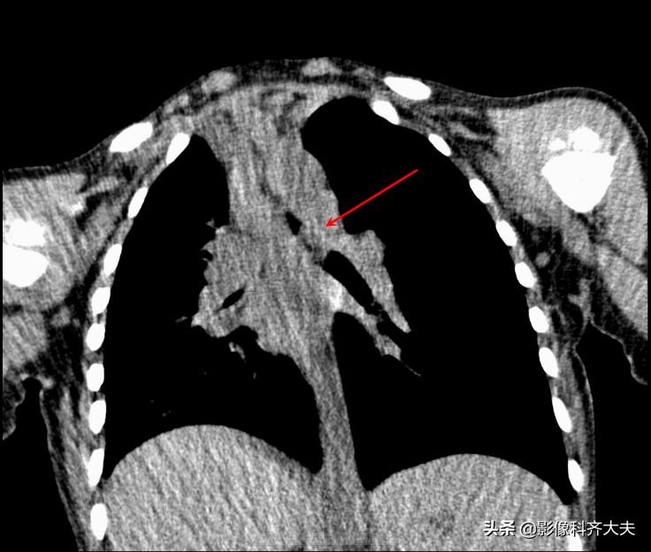 ct能查出气管微小异物嘛,气管异物ct怎么做