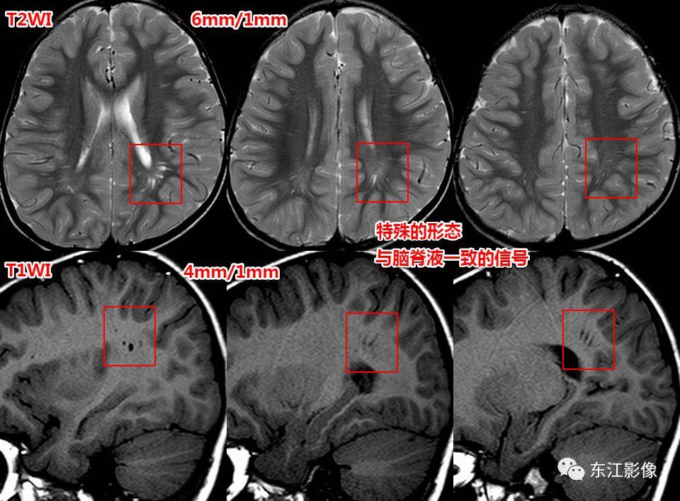 头颅mri扫描影像哪里找,头颅影像mra详细解说