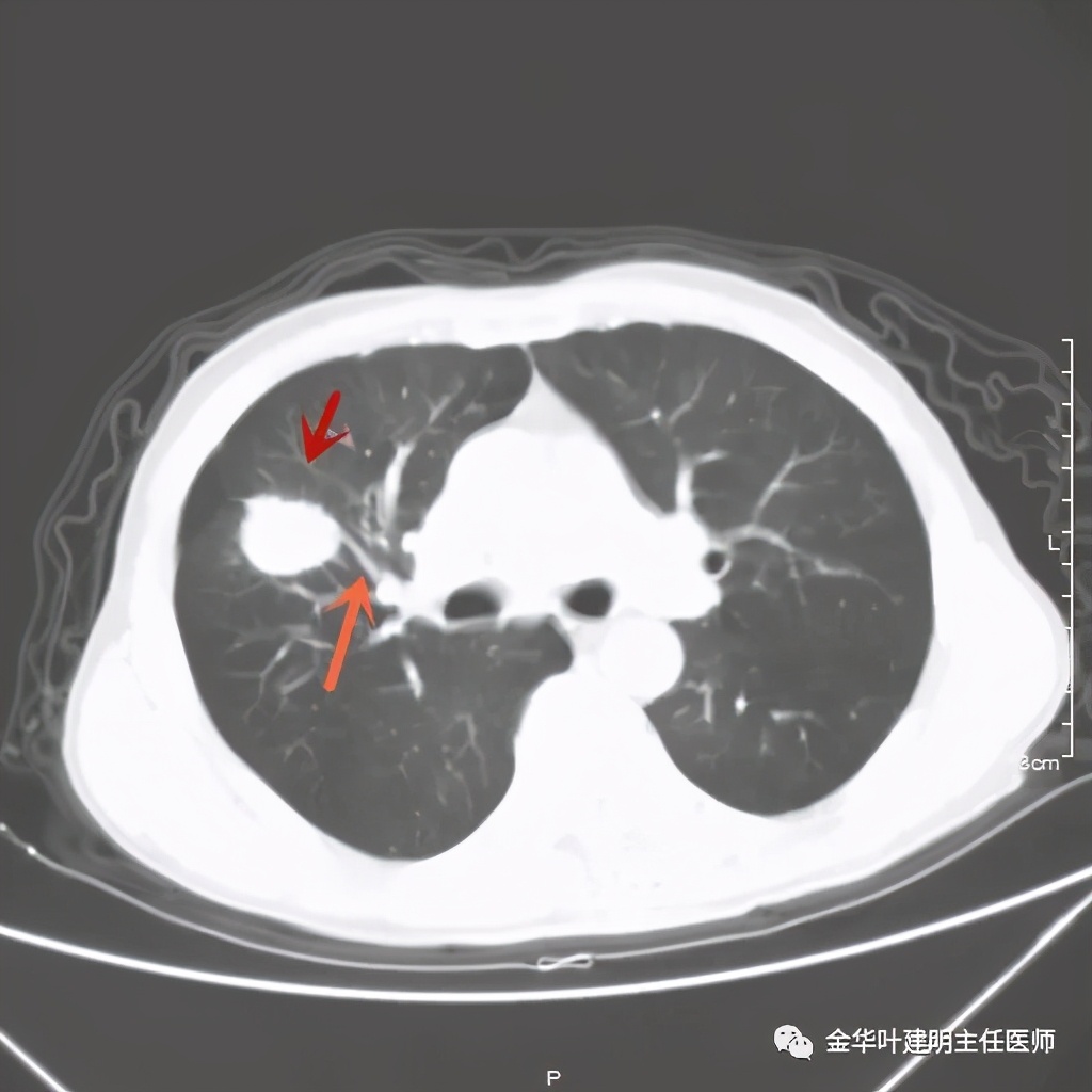得了肺癌做肺部穿刺有影响吗,肺部穿刺可以确诊肺癌吗
