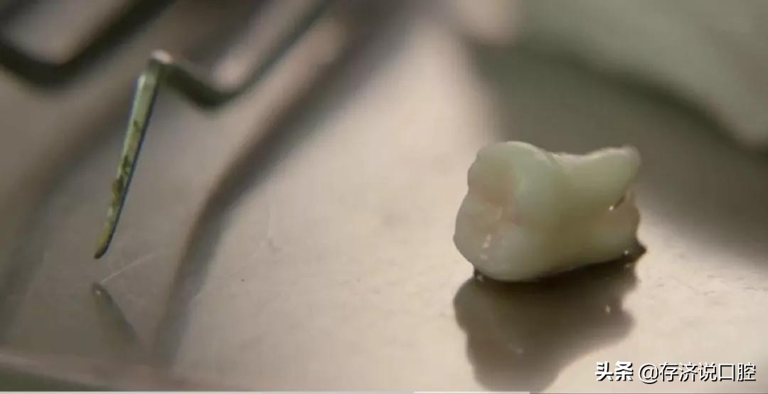 为什么有些人拔牙脸会肿,为什么拔牙第二天脸肿得更厉害