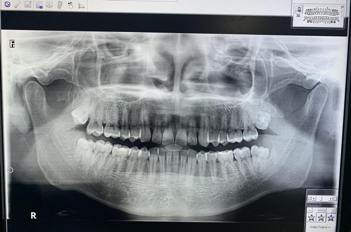 拔智齿拆线有什么要注意的吗,拔智齿后注意事项和饮食食谱大全