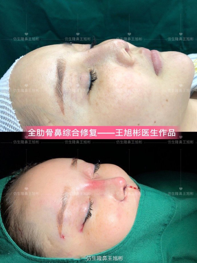 骨粉注射隆鼻皮肤变薄怎么办,线雕隆鼻会引起鼻挛缩吗