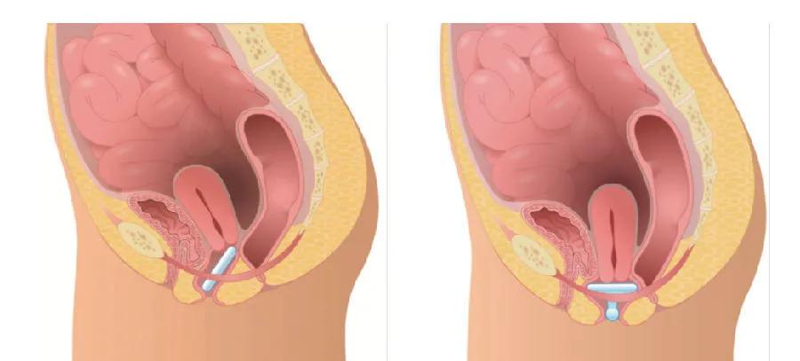 咳嗽漏尿盆腔痛,咳嗽漏尿导致外阴溃烂