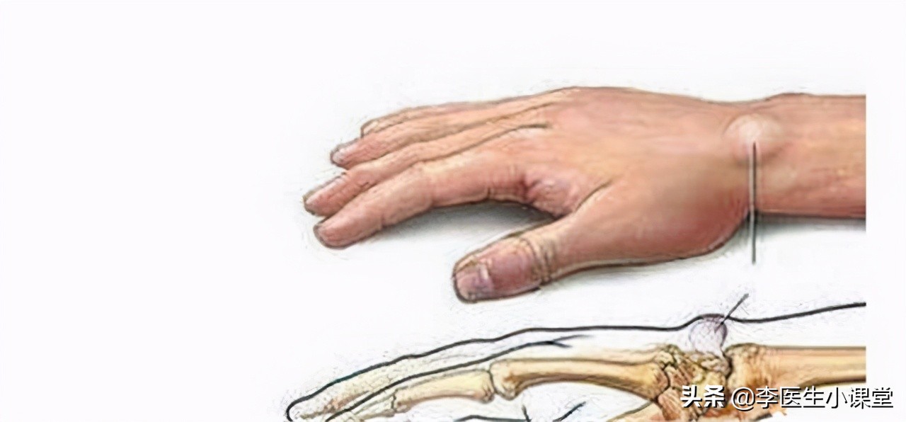 更年期易得腱鞘炎怎么办,更年期腱鞘炎最佳治疗方法