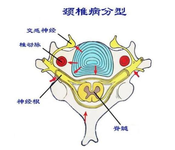 颈椎病腰椎病不用慌,颈椎病不用怕五个药方