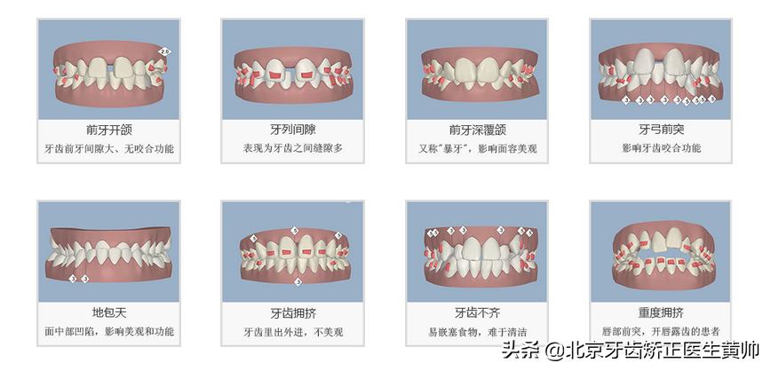 腺样体肥大牙齿矫正最佳年龄,儿童龅牙牙齿矫正最佳年龄