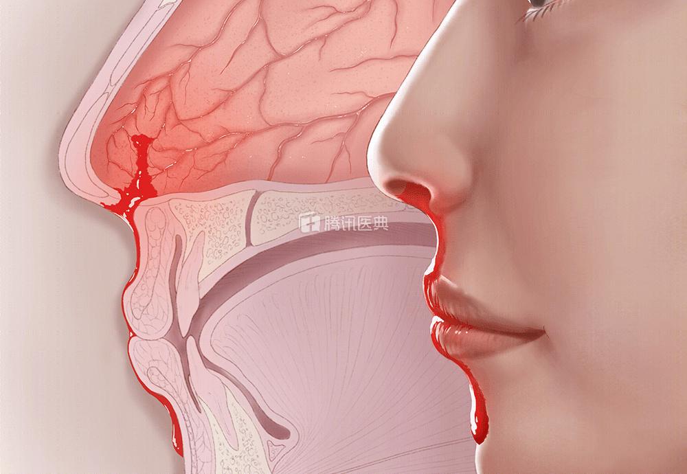 孩子一天流鼻血三次血量挺多的,孩子一天流三次鼻血一打喷嚏就流