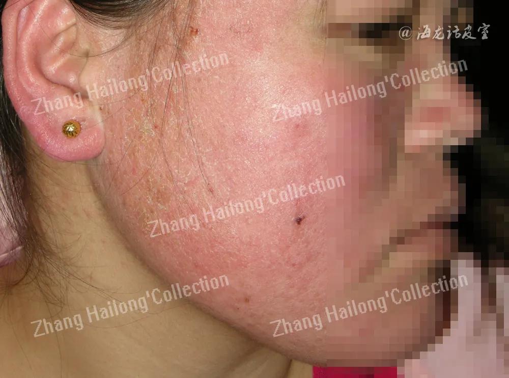 激素依赖性皮炎饮食注意事项,激素依赖性皮炎用什么护肤品