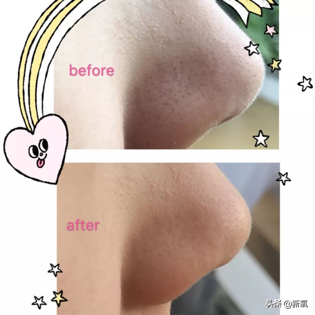 目前有真正去黑头的方法,最近超火的去黑头