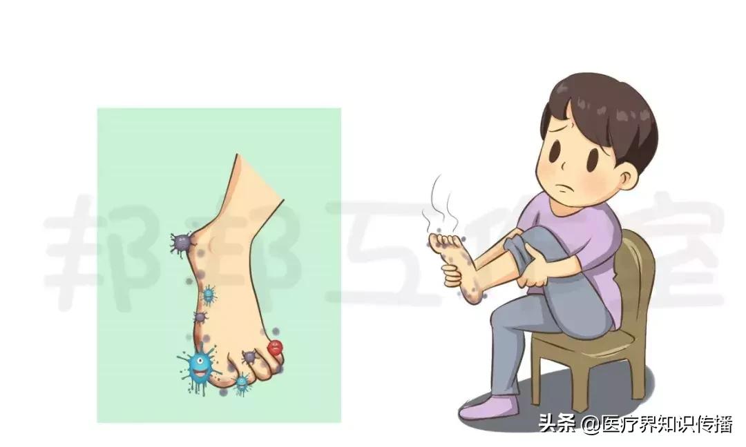 脚气怎么不用药治疗,鳞屑角化型脚气可以彻底治愈吗