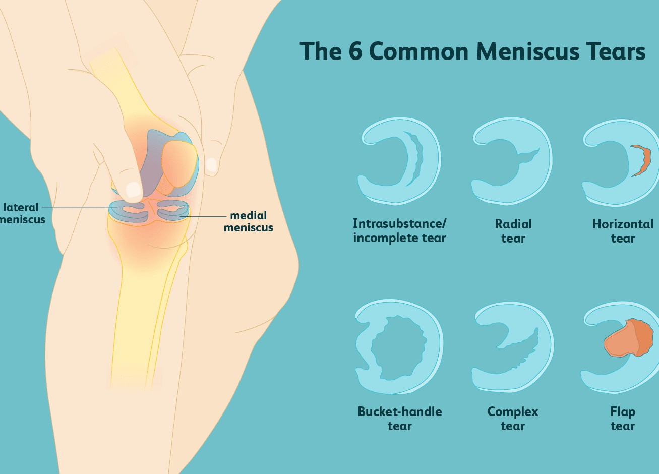半月板撕裂诊断,半月板损伤撕裂要问医生哪些问题