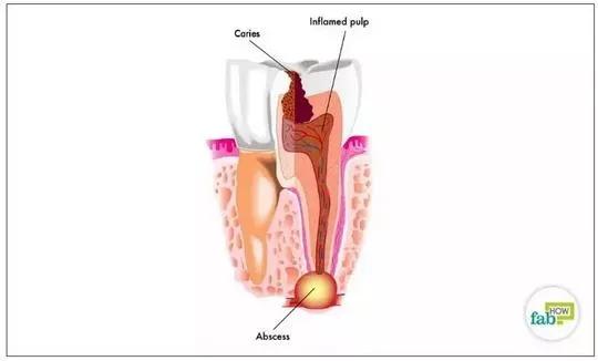 日常的牙病如何护理,疫情期间牙齿怎么修复