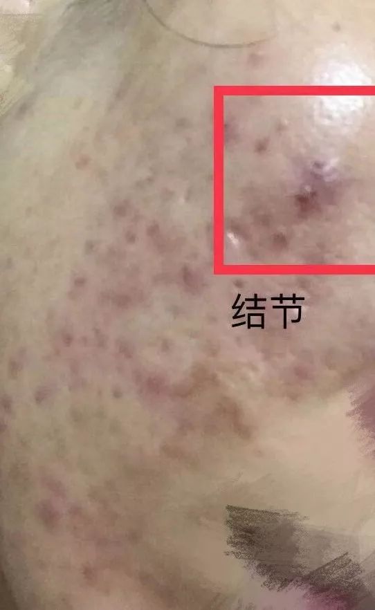 背部长痘挤出来有恶臭味,背部长痘是什么原因