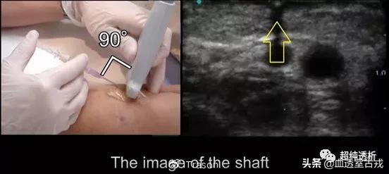 超声引导下血管穿刺效果评价,超声引导下血管穿刺置管流程
