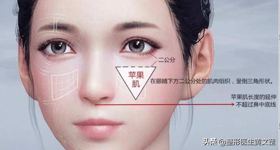 填充苹果肌能够改善脸部松弛吗,填充苹果肌用大分子还是小分子