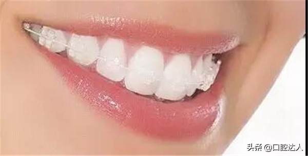 牙齿矫正步骤流程,牙齿矫正怎么操作