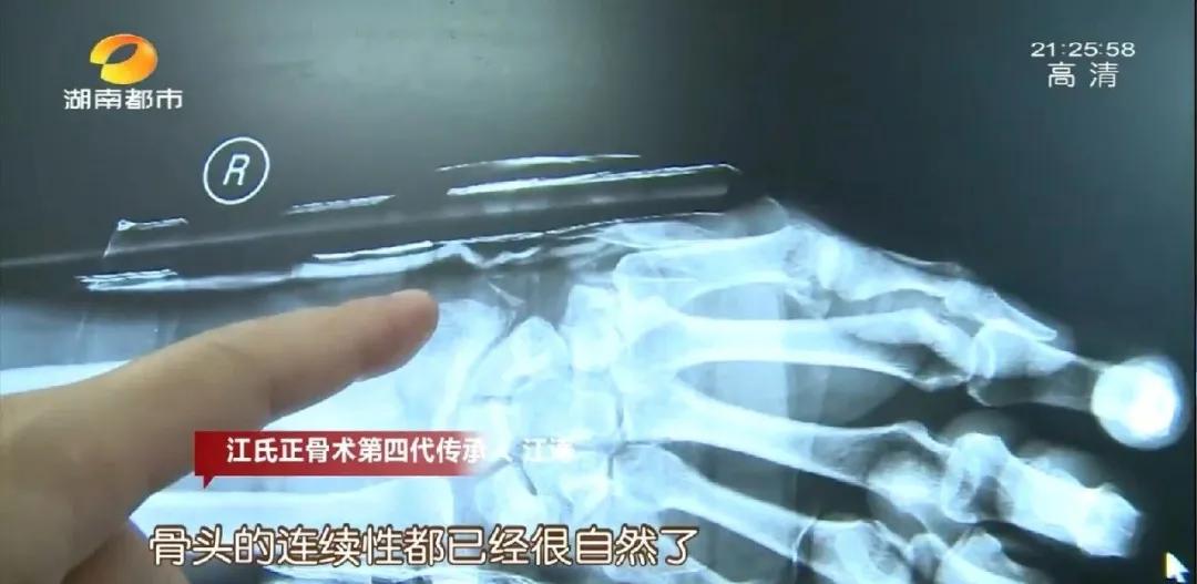 断骨手法复位视频,身怀绝技全集