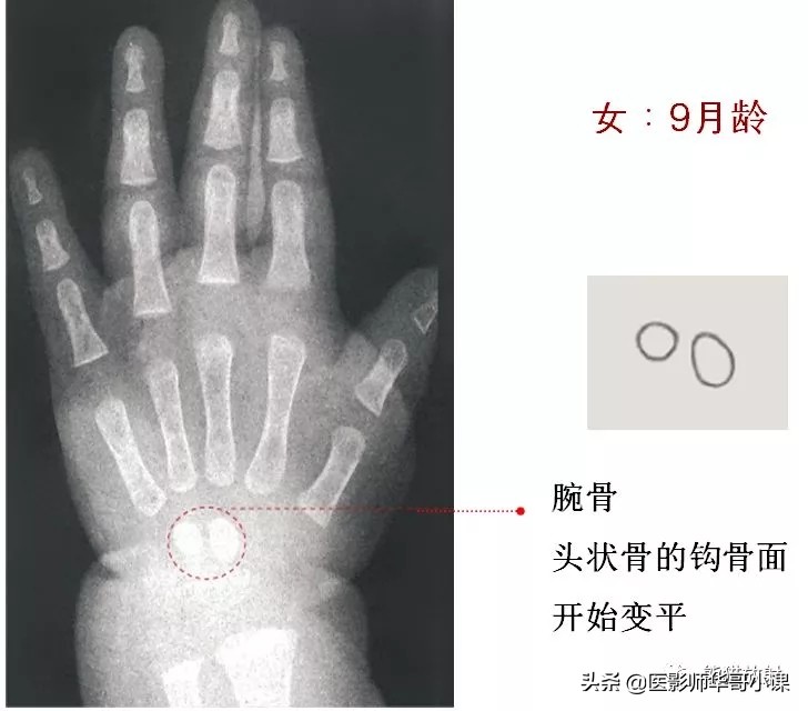 骨龄片对照图谱测骨龄准不,骨龄14岁男孩骨龄图谱