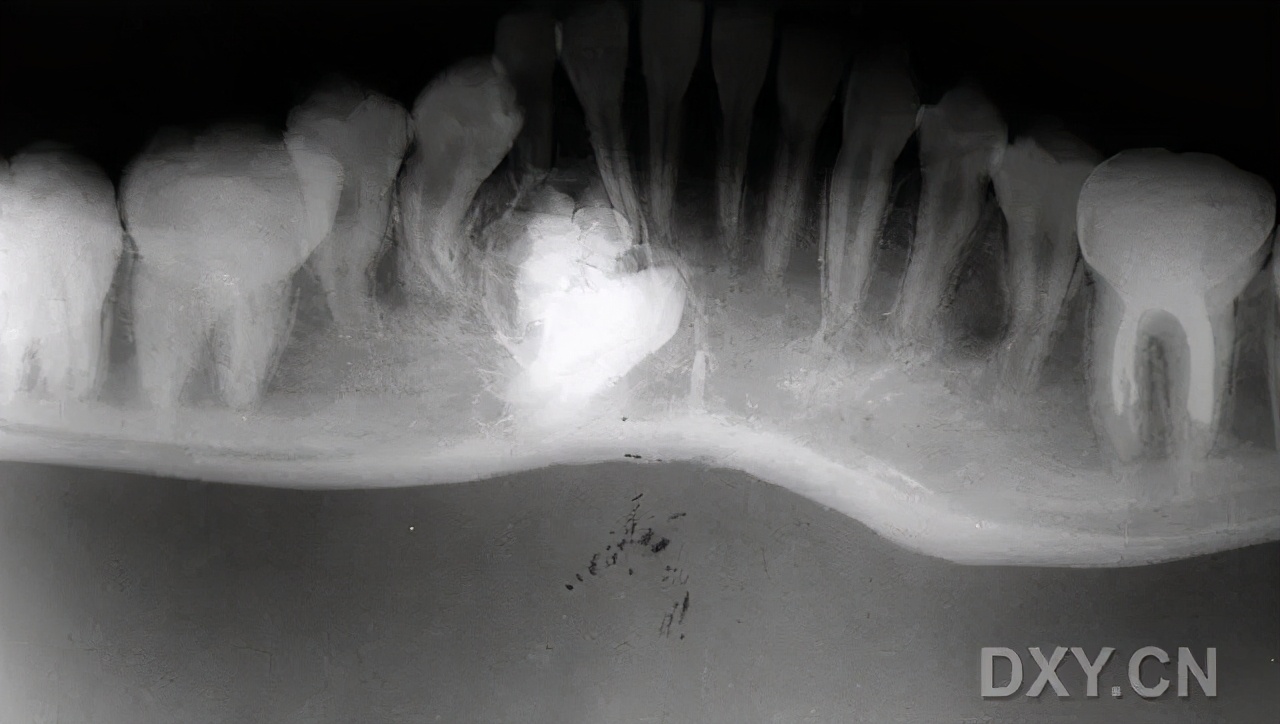 鼻窦囊肿导致脸部疼痛怎么办,鼻窦囊肿导致脸颊疼痛