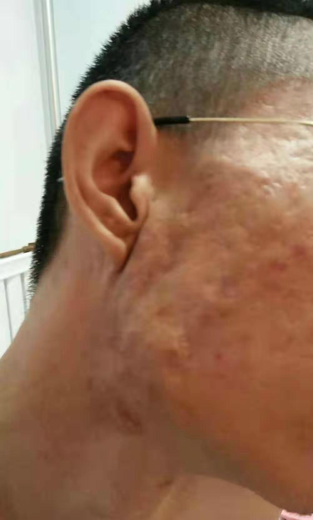 长痘留下难看的痘印痘坑,脸上起痘后留下疤痕如何消除