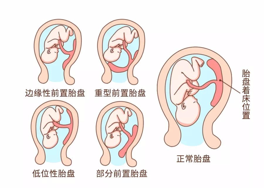 顺产还是剖腹产容易大出血,顺产为什么要转为剖宫产
