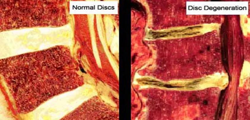 骨科医生久坐缓解方法,骨科大夫严玉贵说久坐危害大