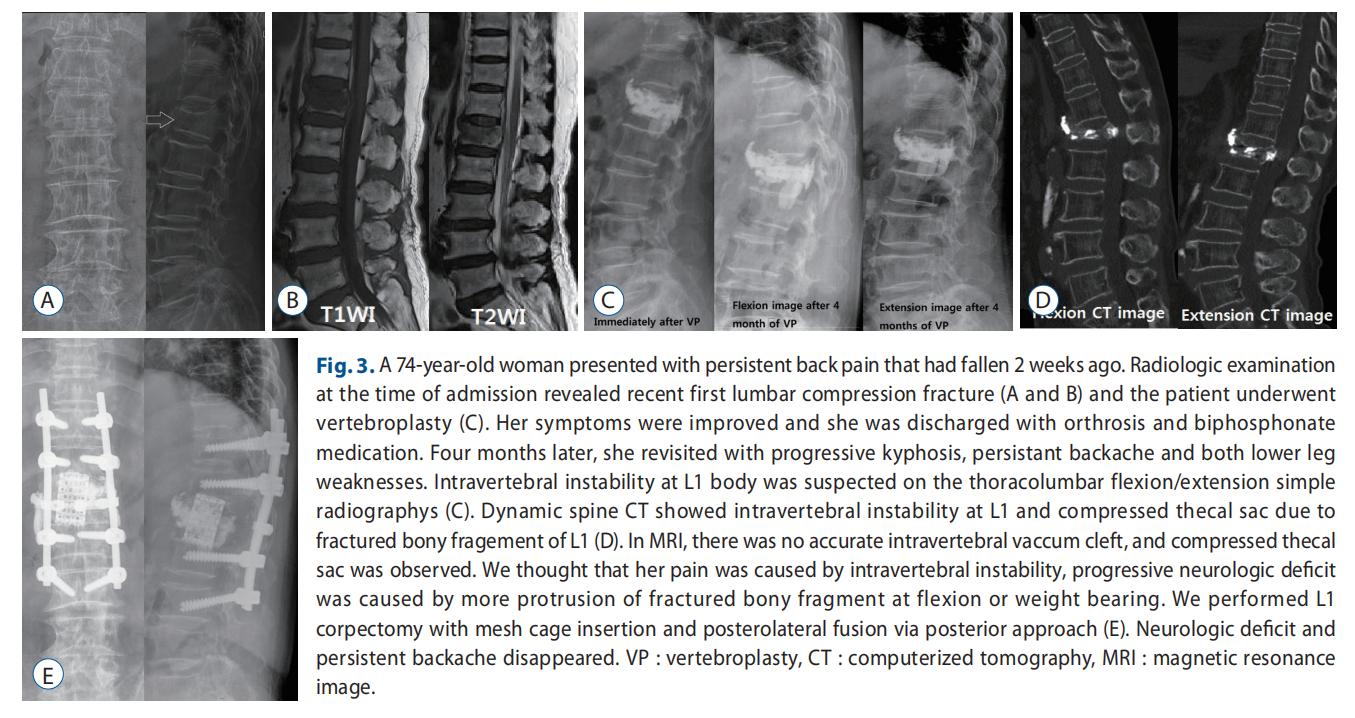 创伤后的右侧颞叶脑出血多久可好,创伤后综合征能恢复吗