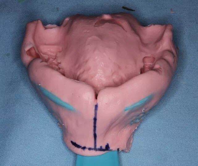 咬合重建详细步骤,如何制作咬合模型