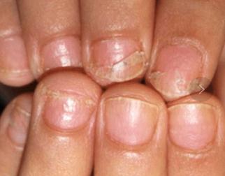宝宝指甲出现白点,孩子指甲上有白色斑点倪海厦