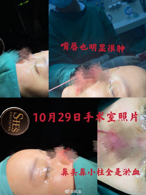 女星高溜整容,演员高溜整容失败欲轻生