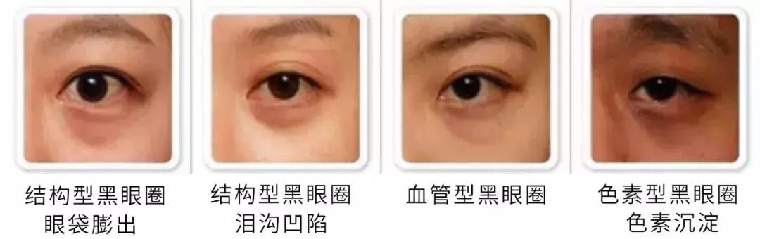有了黑眼圈，就被判了“死刑”？不，用对眼霜就可以