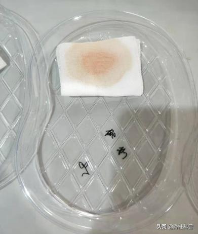 脊柱手术脑脊液漏的临床表现,脊柱术后脑脊液漏的病例