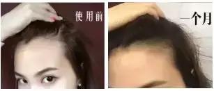 发际线高头发稀疏掉头发怎么拯救,发际线后移的头发还能长出来么
