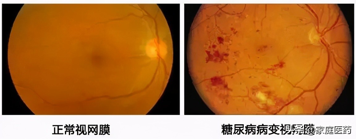 华北地区出现小虫子,东北糖尿病高发地区