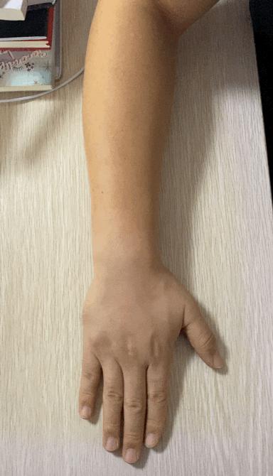 网球肘的自我锻炼三个动作,一个动作解决网球肘