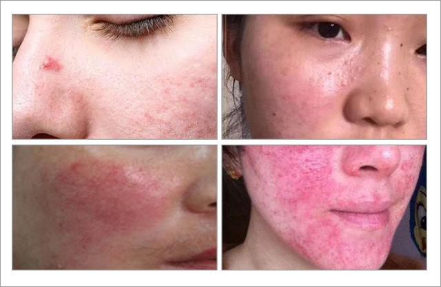 脸上螨虫的正确消灭方法,脸上的螨虫能不能彻底消灭