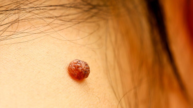 哪些痣易癌变为恶性黑色素瘤呢,如何判断痣会不会恶化成黑色素瘤