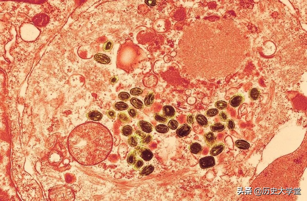 天花被成功消灭的原因,为什么只有天花被彻底消灭了