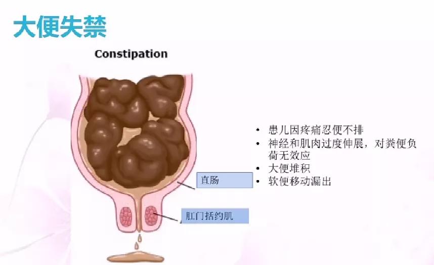儿童便秘的原因和治疗方法,医生小孩便秘怎么调理