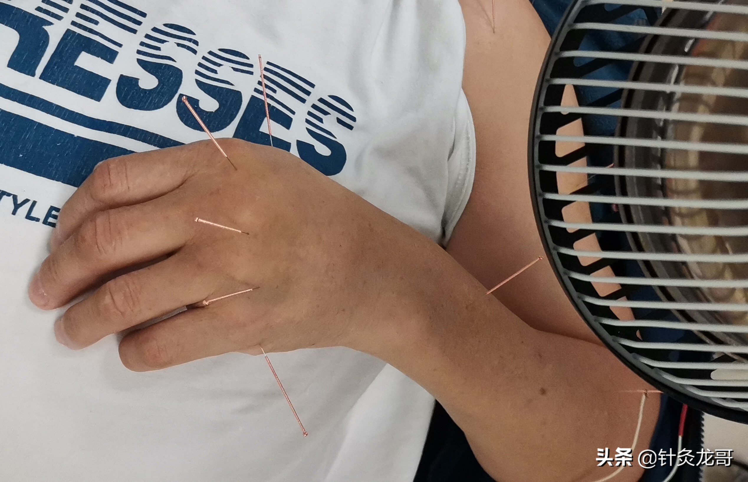 中风后肢体痉挛针灸需补阴泻阳？针刺屈肌就补阴？针伸肌就泻阳？