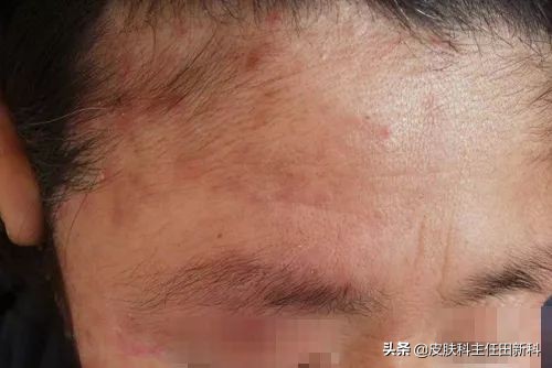脸上痘印变成癣了怎么回事,痘印长癣