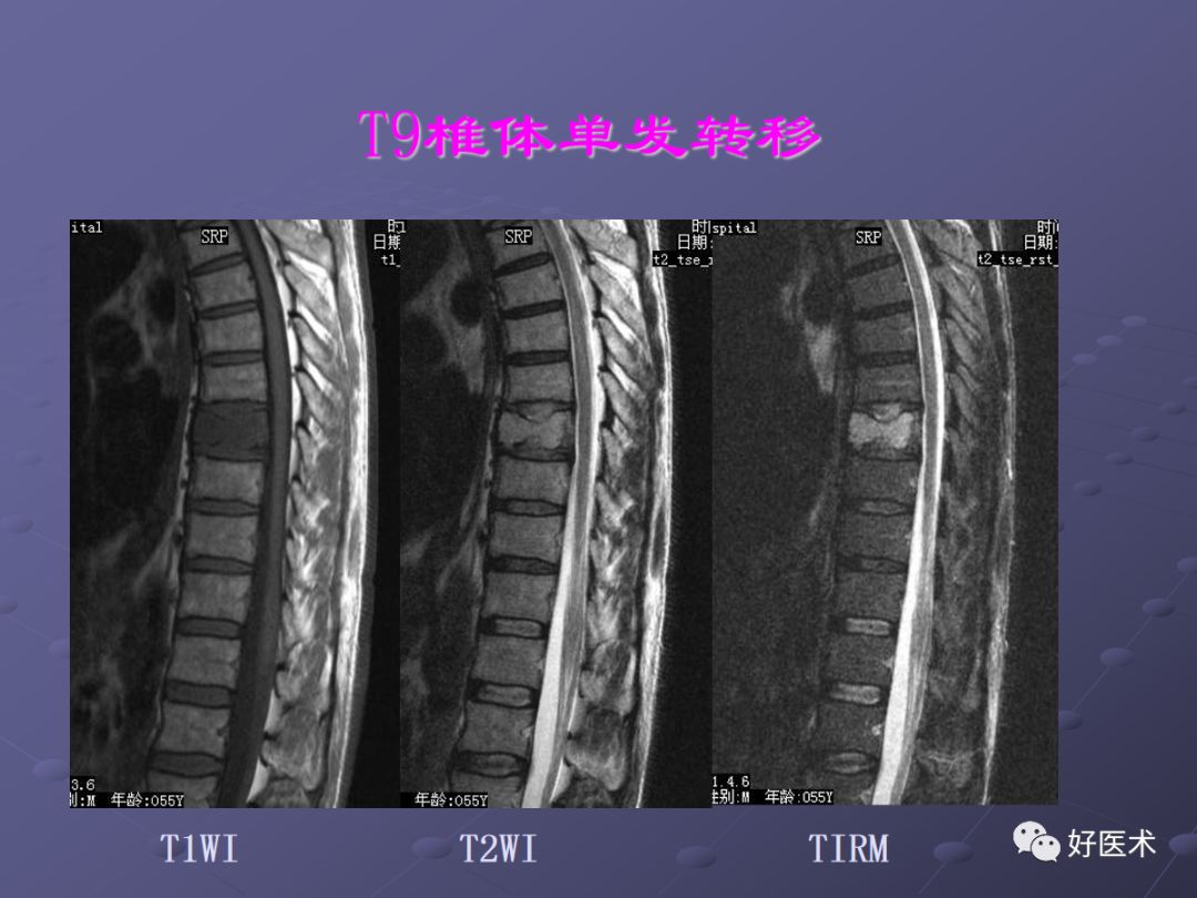 脊柱mri有哪些特点,乳腺疾病的mri诊断及鉴别