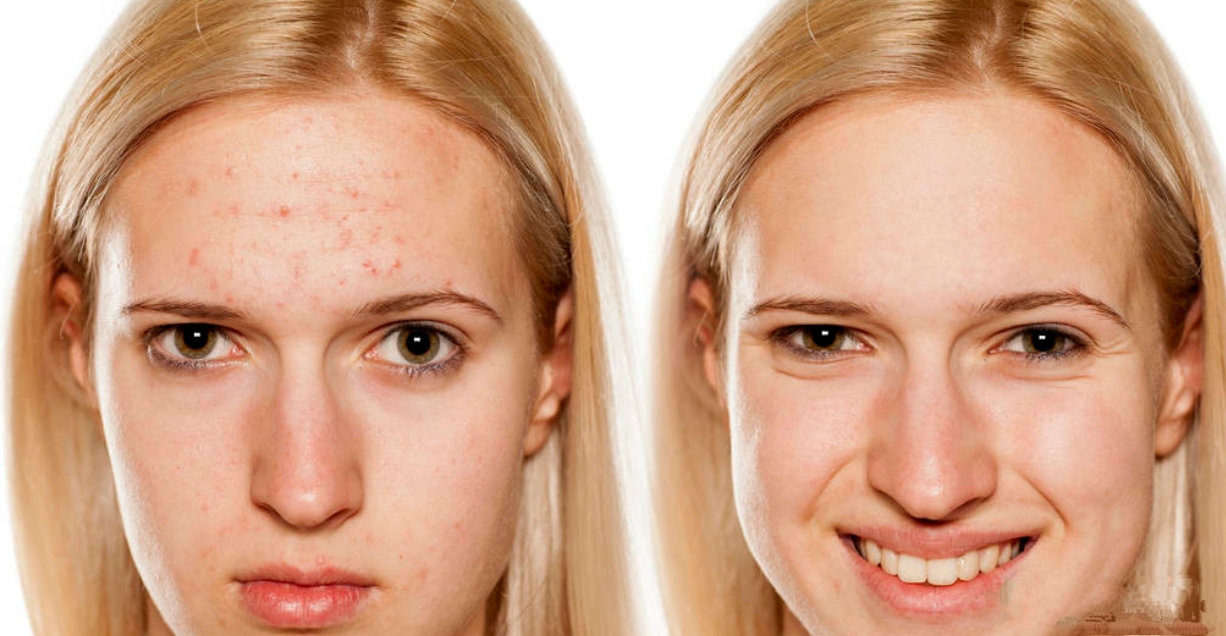如何祛斑10种祛斑的简单最佳方法,祛斑方法教你如何祛斑最快最有效