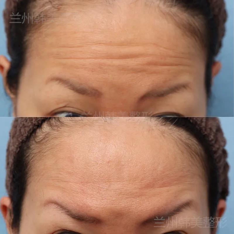 皱纹形成的小视频,皮肤松弛形成皱纹